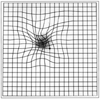 Metamorfopsia: distorção de imagem, em que linhas retas são enxergadas de forma tortuosa.