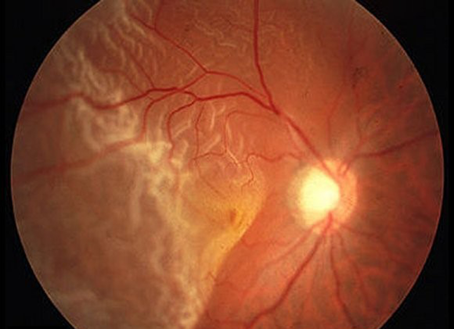 Descolamento de retina Promácula Dr. Nelson Chamma