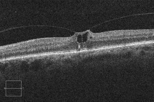 Síndrome de tração vítreo-macular – Imagem de OCT Fonte: http://eyewiki.org/